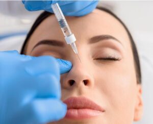 Non-surgical rhinoplasty nose filler