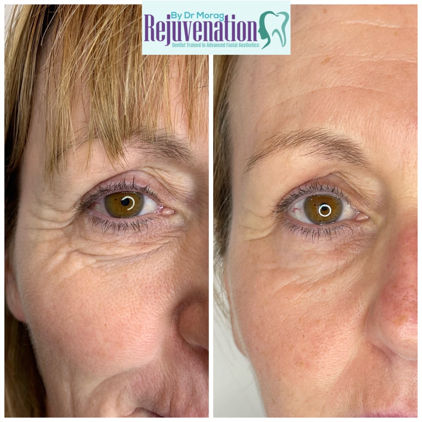 Viscoderm Hydrobooster®