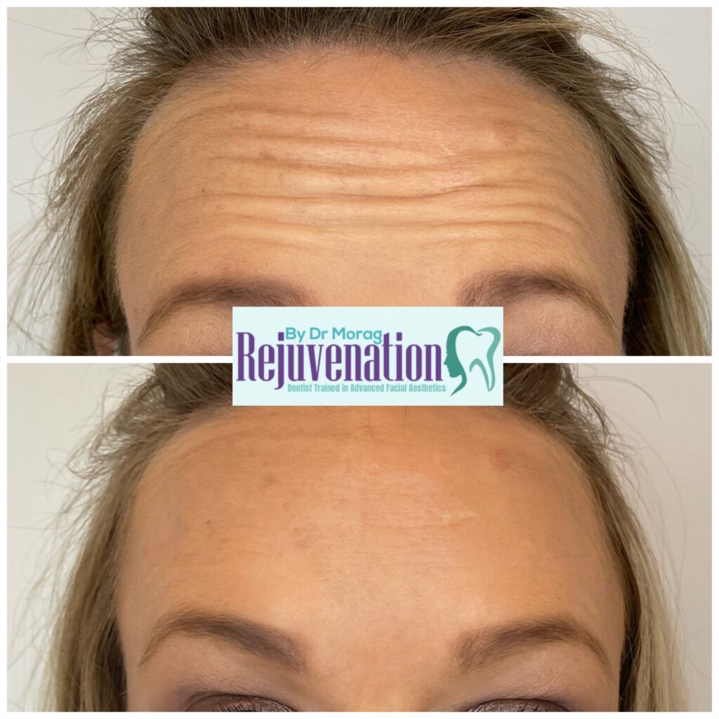 Anti Wrinkle Treatments