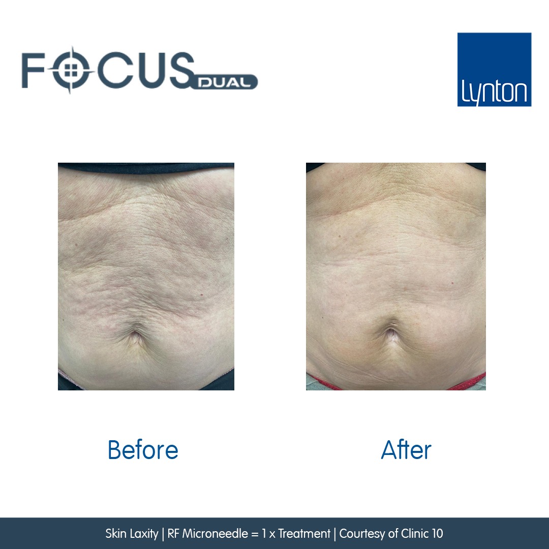Before and After. Focus Dual. 7. Skin Laxity. RFM. Clinic 10 (1)