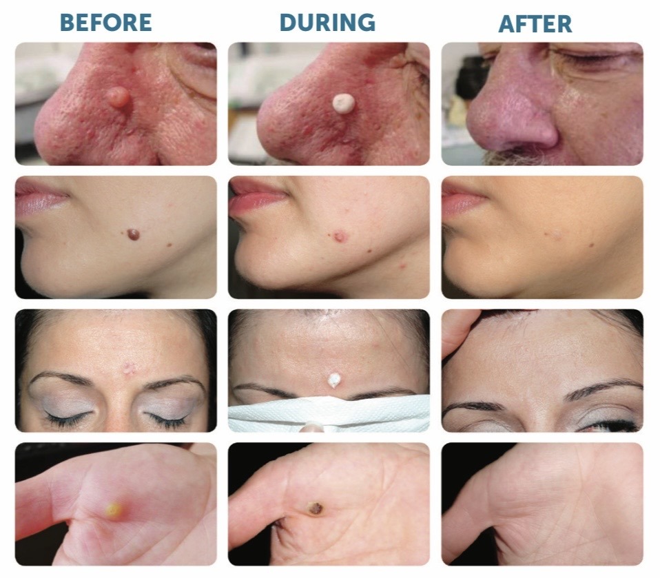 Before & after results Cryopen