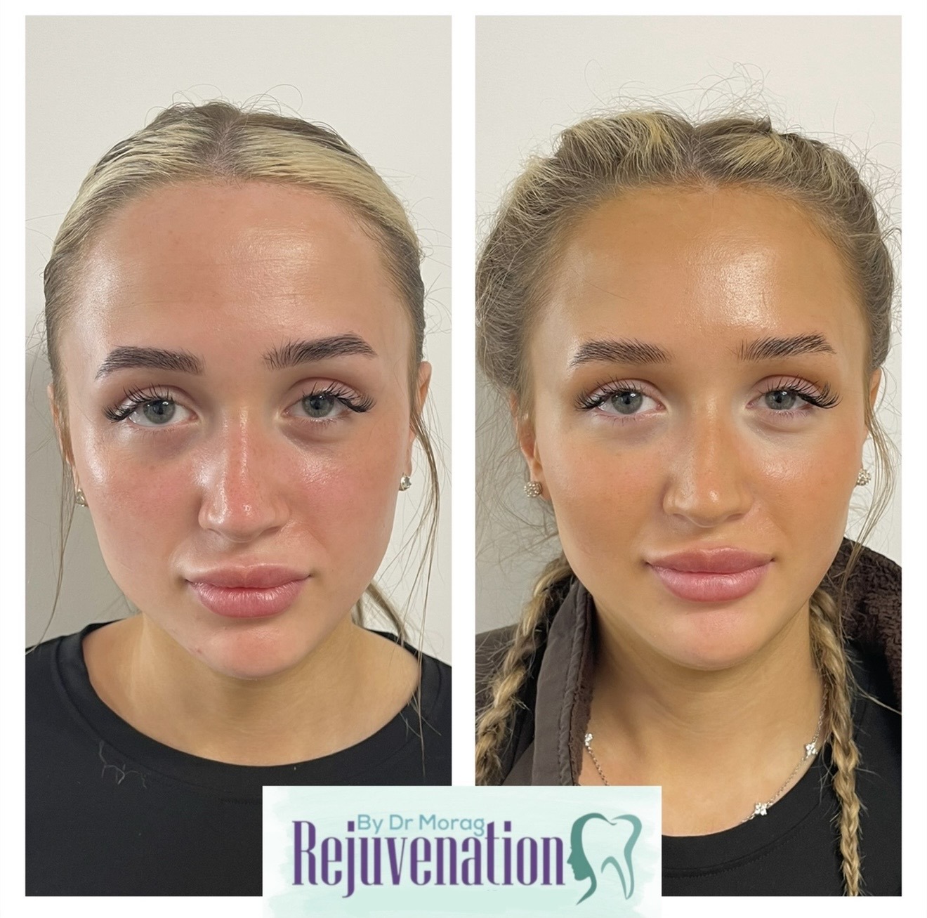 Cheek Filler, younger patient