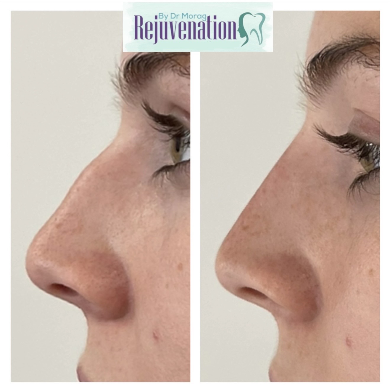 Non-surgical Rhinoplasty