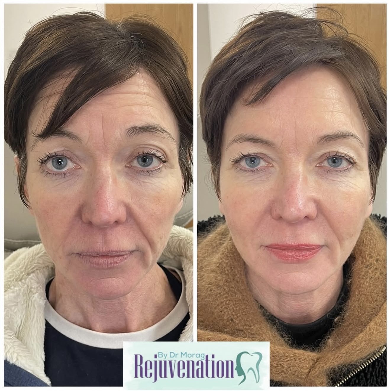Full Face Rejuvenation