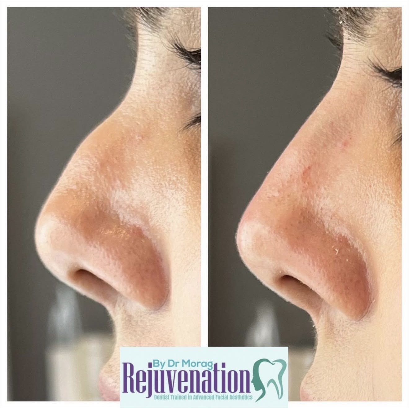 Non-surgical Rhiniplasty