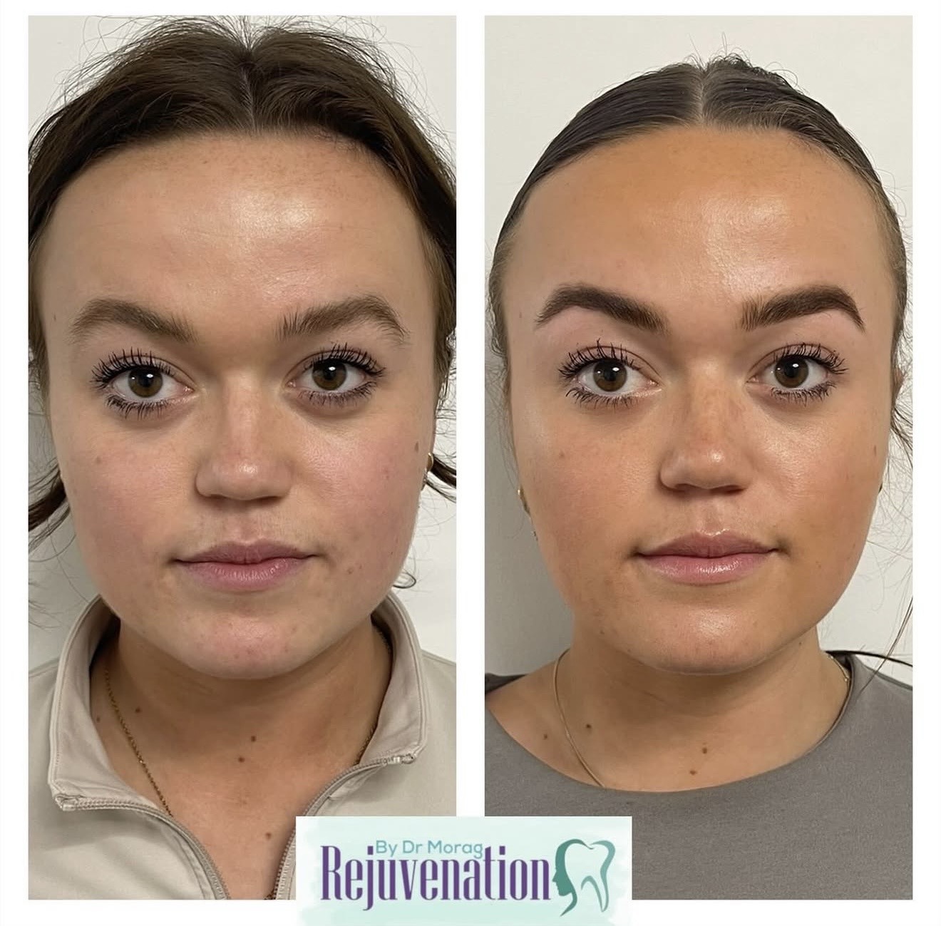 Masseter botox, jawline slimming before and after