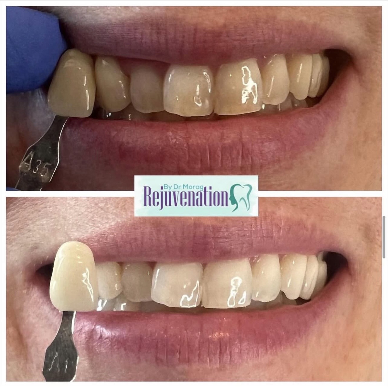 Teeth whitening before & after