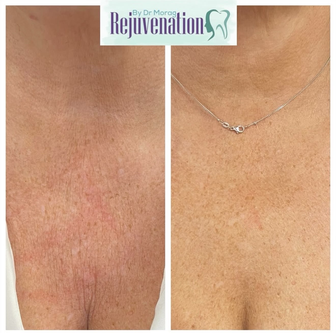 Decolletage Radiesse