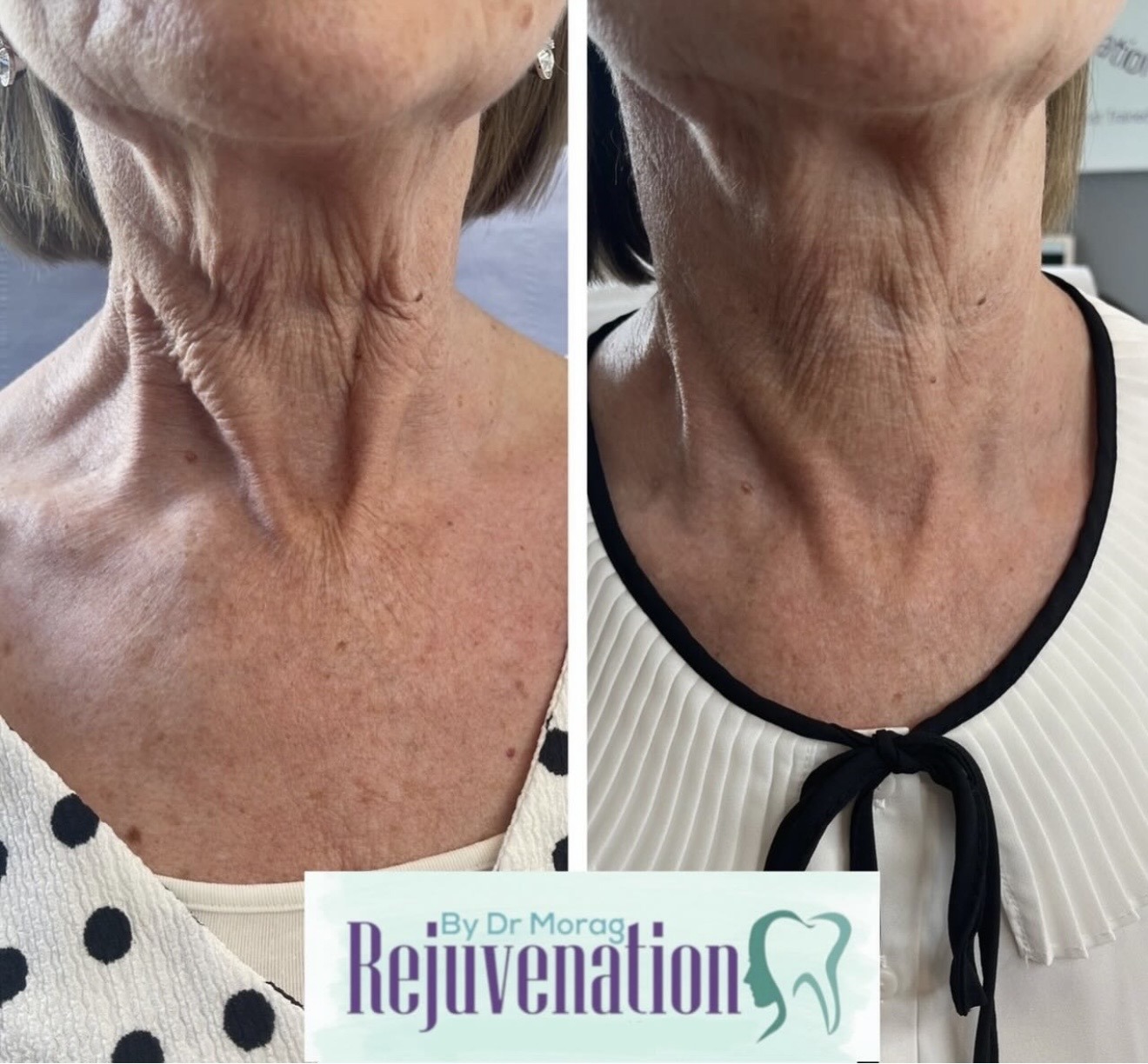 Neck profhilo before and after