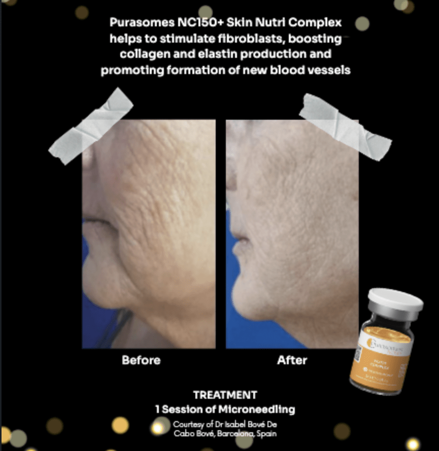Exosomes before & after photo