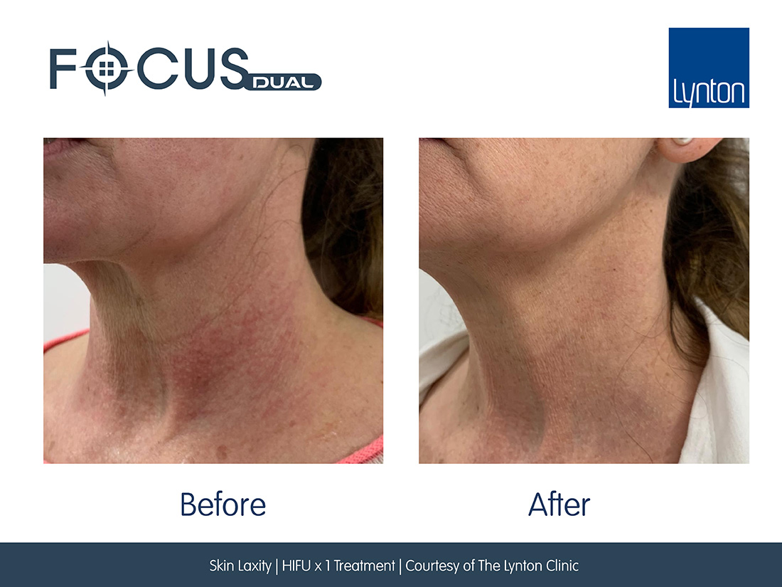Skin Laxity HIFUx1