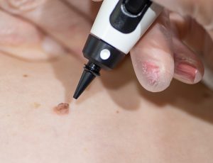 Cryopen cryotherapy benign lesion mole removal